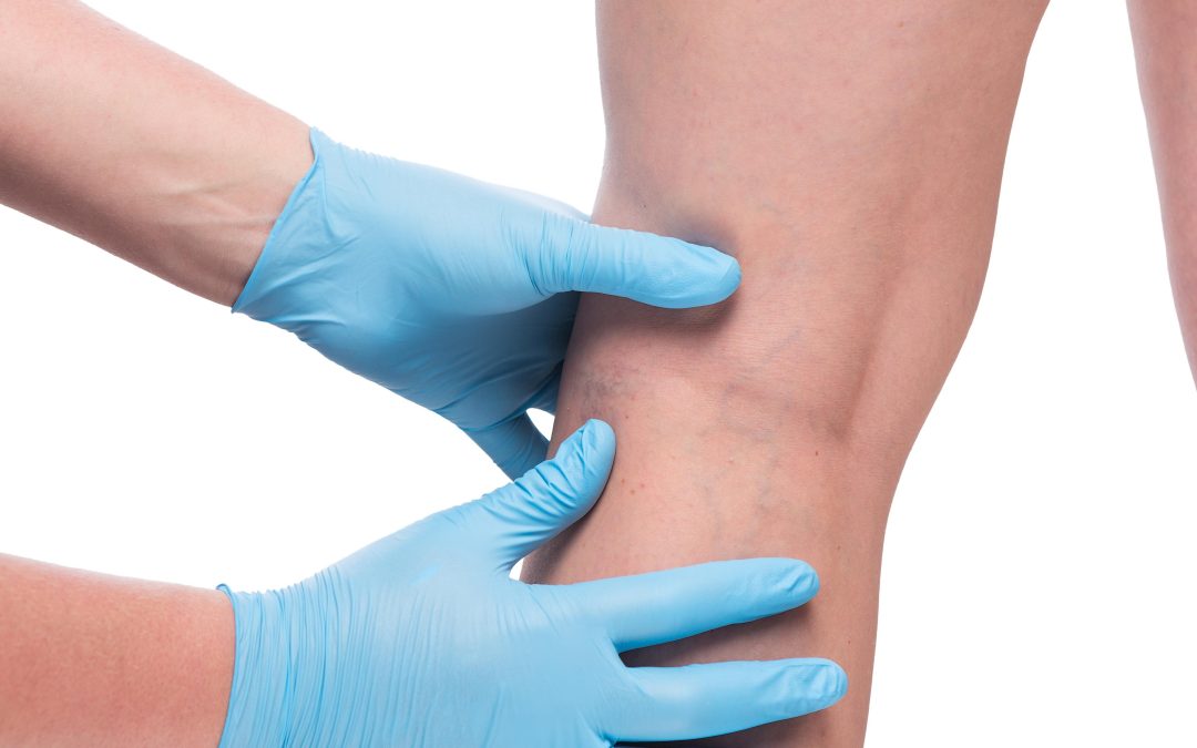 Achieve Smooth Legs with Spider Veins Treatment in Norfolk, VA, for Lasting Confidence