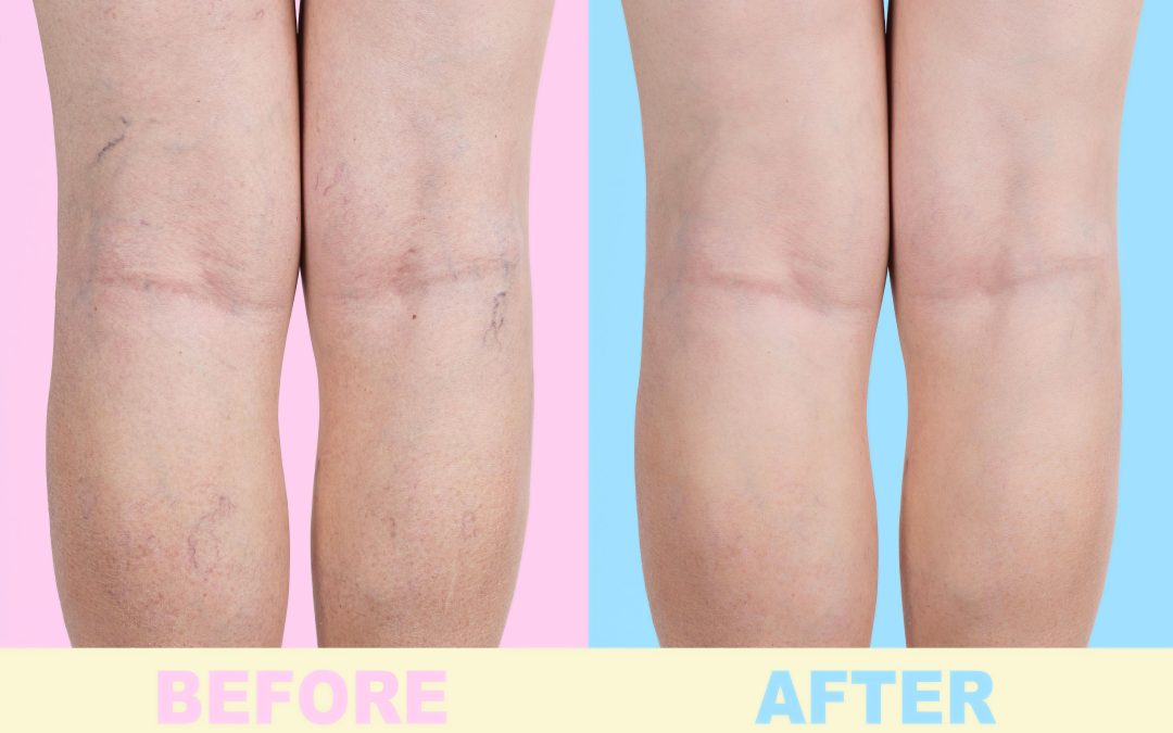 Relief from Leg Pain with Varicose Veins Treatment in Richmond, VA, for Lasting Comfort