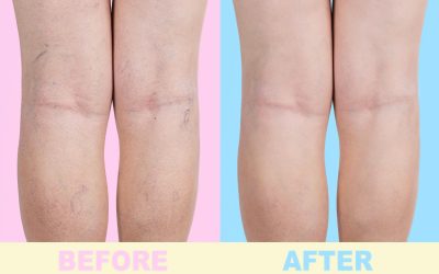 Relief from Leg Pain with Varicose Veins Treatment in Richmond, VA, for Lasting Comfort