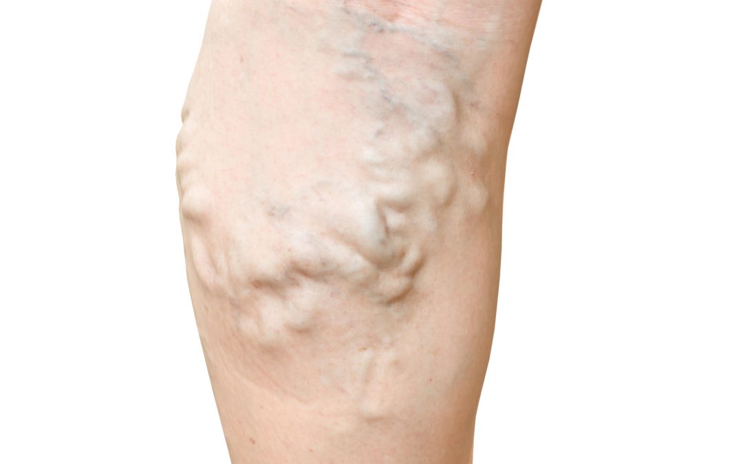 Find Relief from Leg Pain with an Experienced Vein Specialist in Warrenton, VA