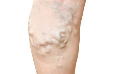 Find Relief from Leg Pain with an Experienced Vein Specialist in Warrenton, VA