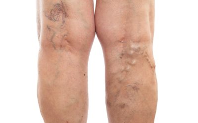 Understanding your options for lasting Spider Veins Treatment in Richmond, VA, solutions