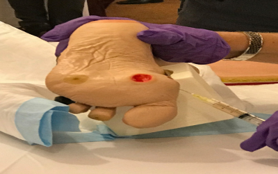 The Role of Bunion Braces in Pain Management and Long-Term Relief