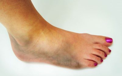 Relieve Leg Pain by Consulting a Varicose Veins Doctor in the Bay Area for Effective Care